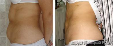 iposuction --  before and after operation ///liposuction cost //// 