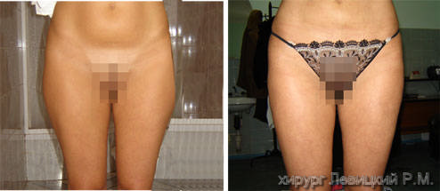  Liposuction --  before and after operation ///liposuction cost //// liposuction prices ////  liposuction procedure 